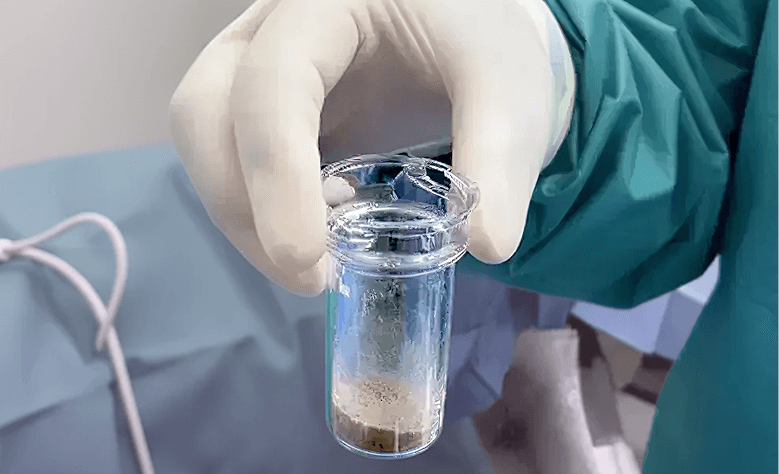 A surgeon in scrubs holding a container of kidney stones collected with the CVAC System