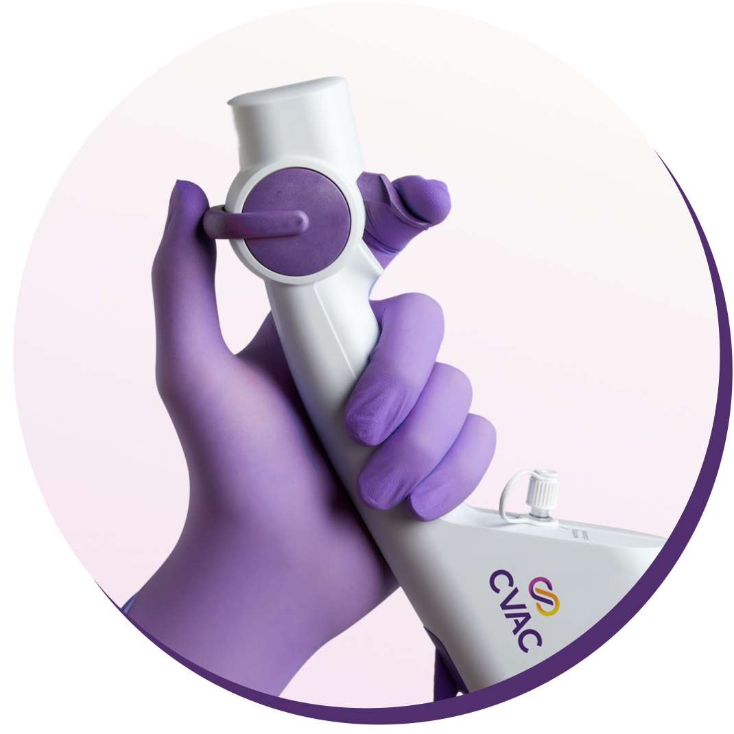 A physician’s gloved hand holding the handpiece of the CVAC System kidney stone treatment