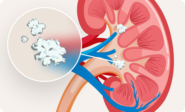 An illustration of a kidney showing where a physician may find kidney stones