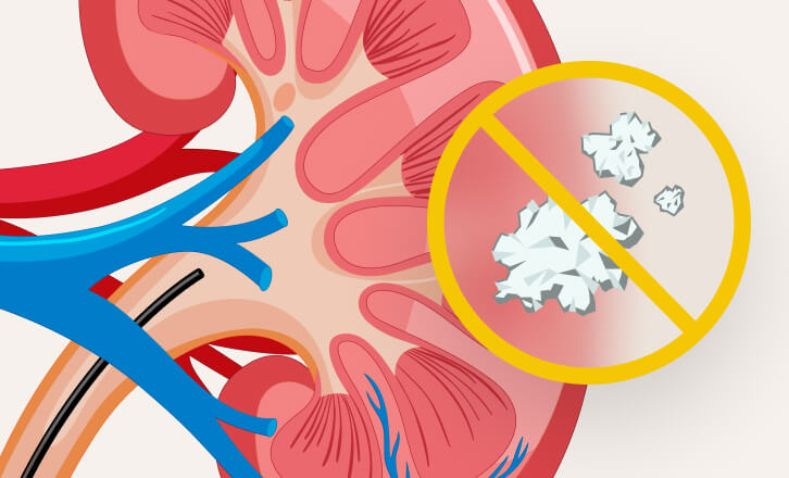 An illustration of a kidney showing where kidney stones may be removed with the CVAC System