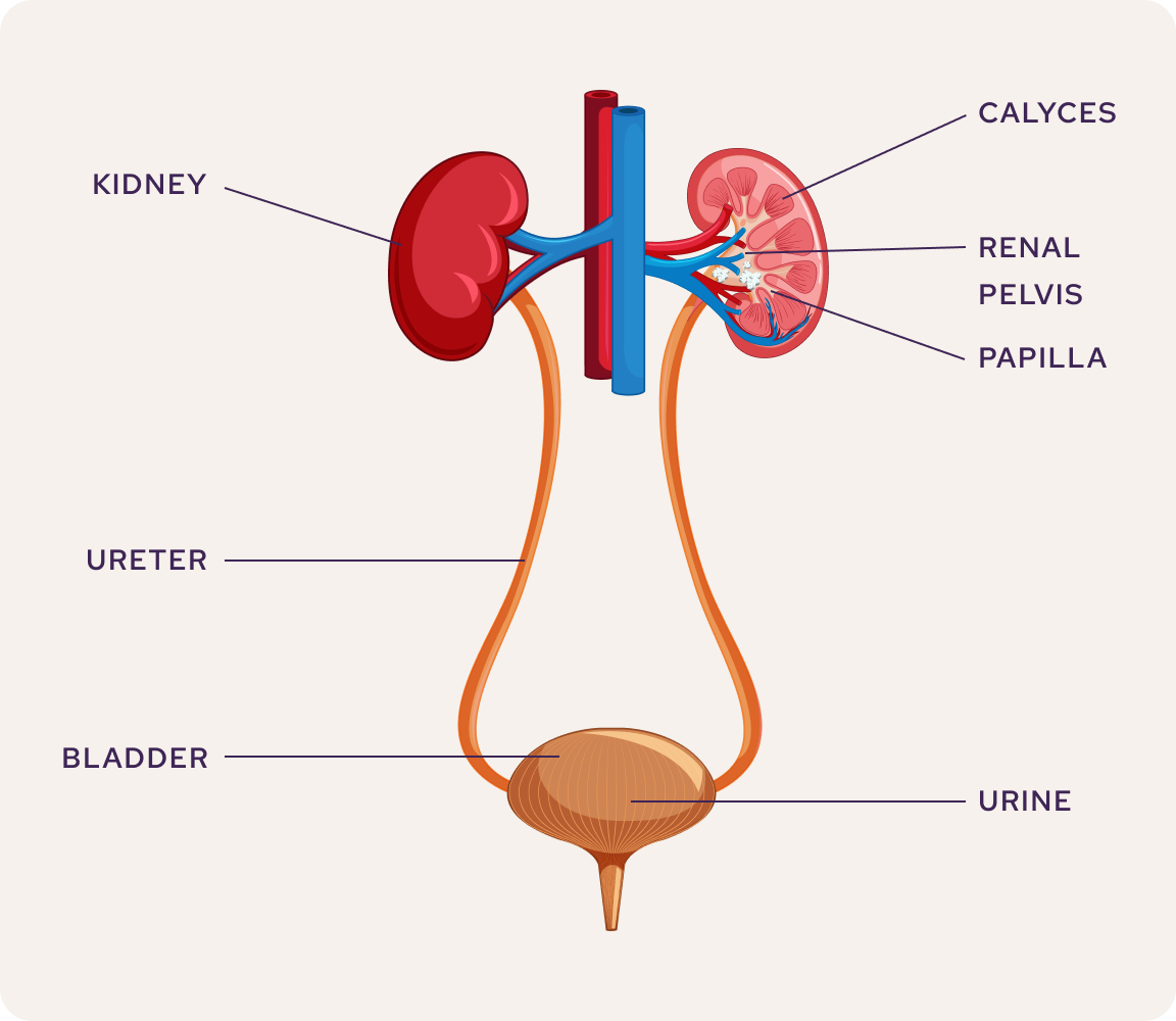 An diagram of the urinary tract showing where kidney stones can occur