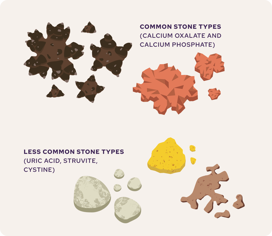 An illustration showing more and less common forms of kidney stones