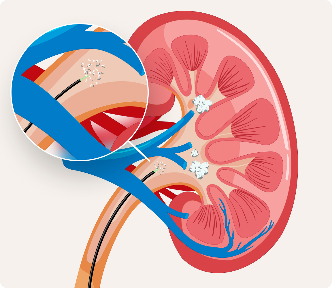 A diagram of a kidney showing how the CVAC System vacuums out kidney stones