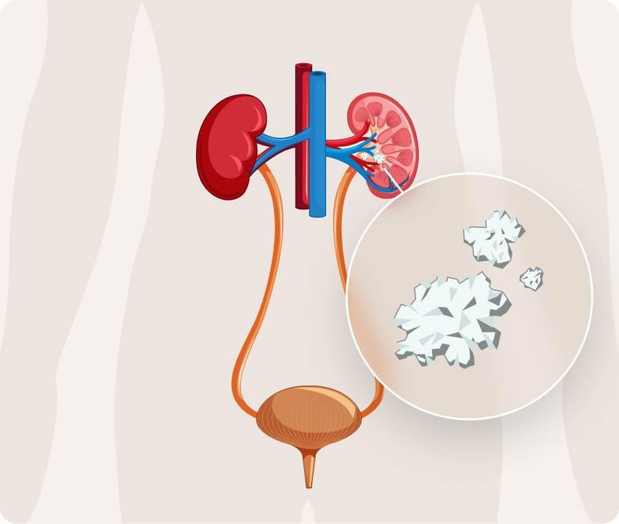 An diagram of the urinary tract showing where kidney stones can occur