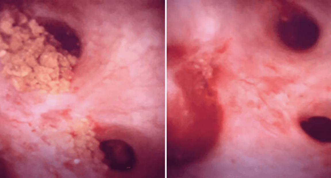 Kidney stone treatment results without the CVAC System and with the CVAC System